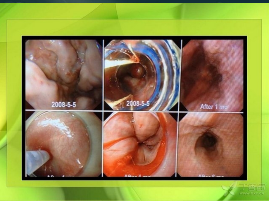 医学课件食管胃底静脉曲张破裂出血.ppt_第1页