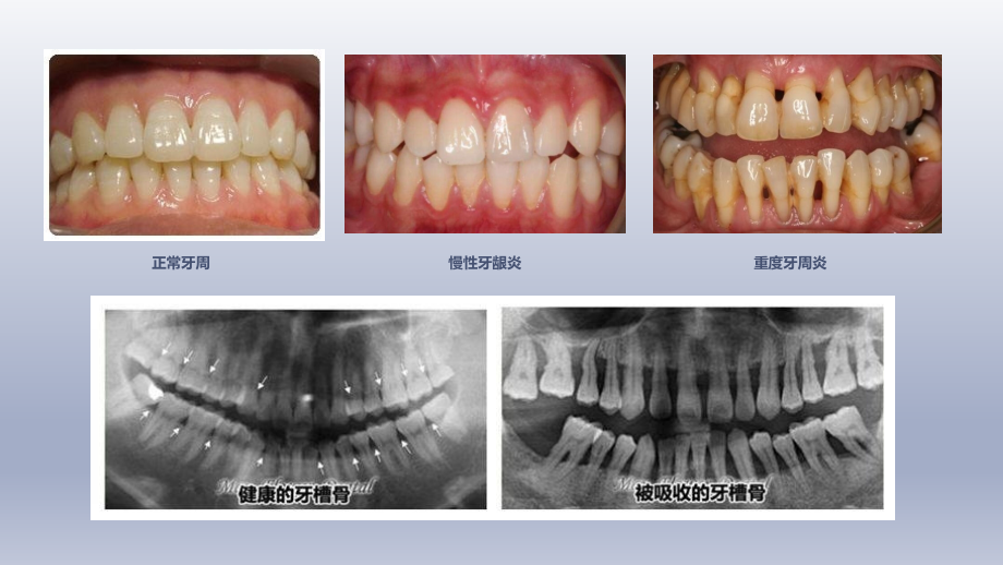 医学课件关于重度牙周炎的治疗.ppt_第2页