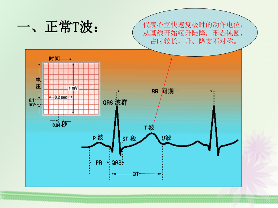 T波改变的临床意义.ppt_第2页