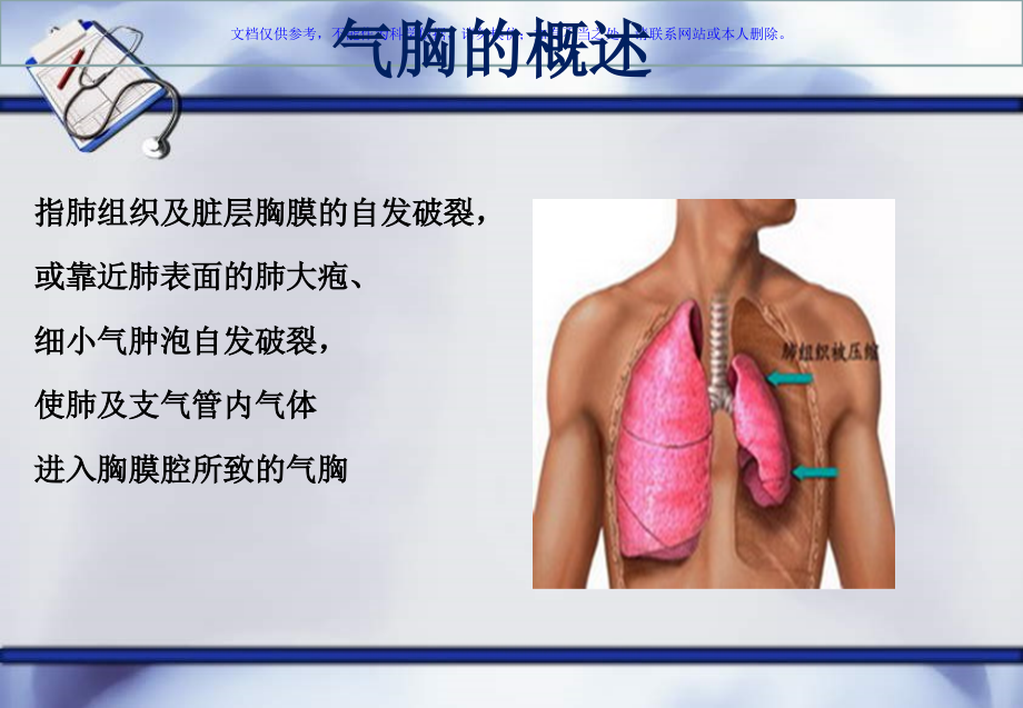 张力性气胸护理查房课件.ppt_第2页
