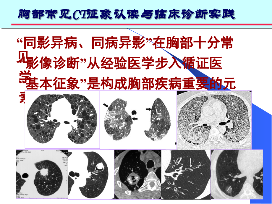 医学胸部常见CT十大征象的诊疗和应用.ppt_第2页