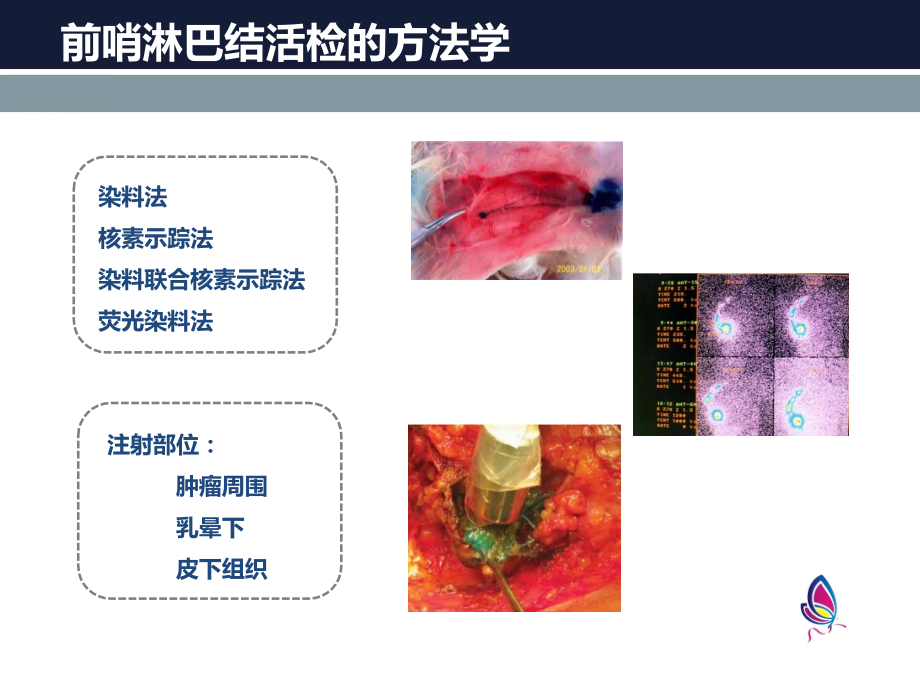 早期乳腺癌前哨淋巴结活检指南主题讲座课件.ppt_第2页