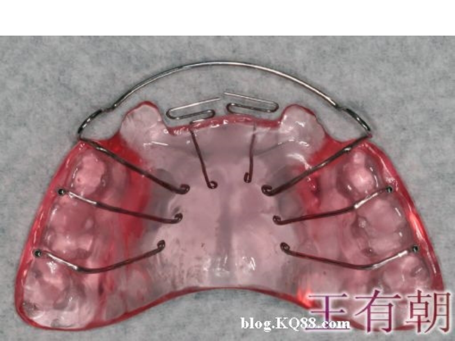 医学正畸活动矫治器图谱专题.ppt_第2页