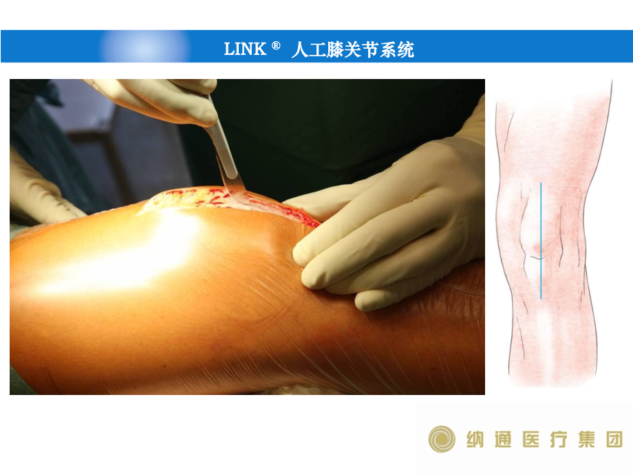 link-膝关节手术操作-.pptx_第2页