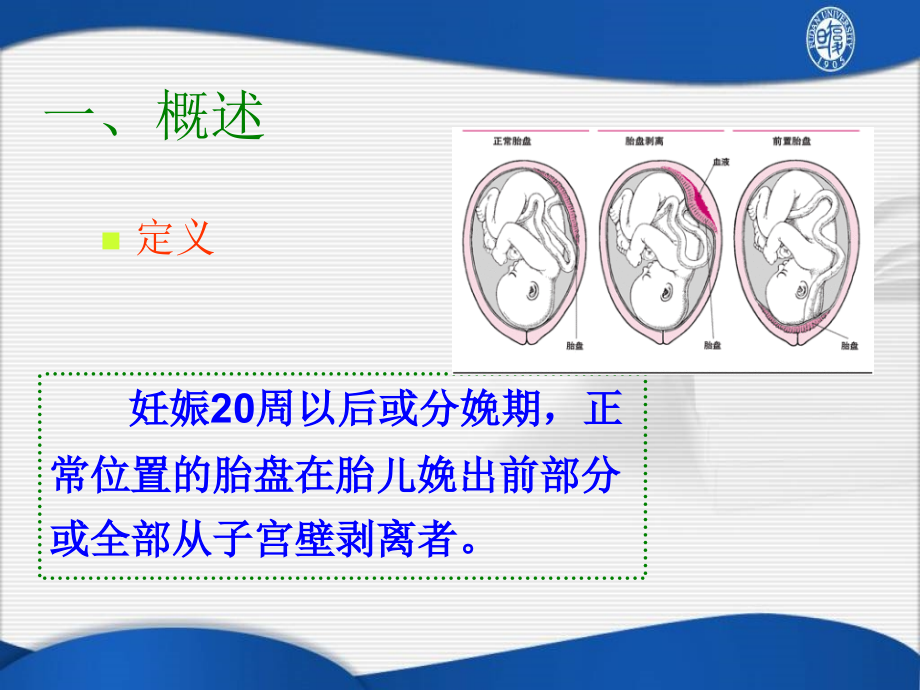 胎盘早剥Placentalabruption.ppt_第2页