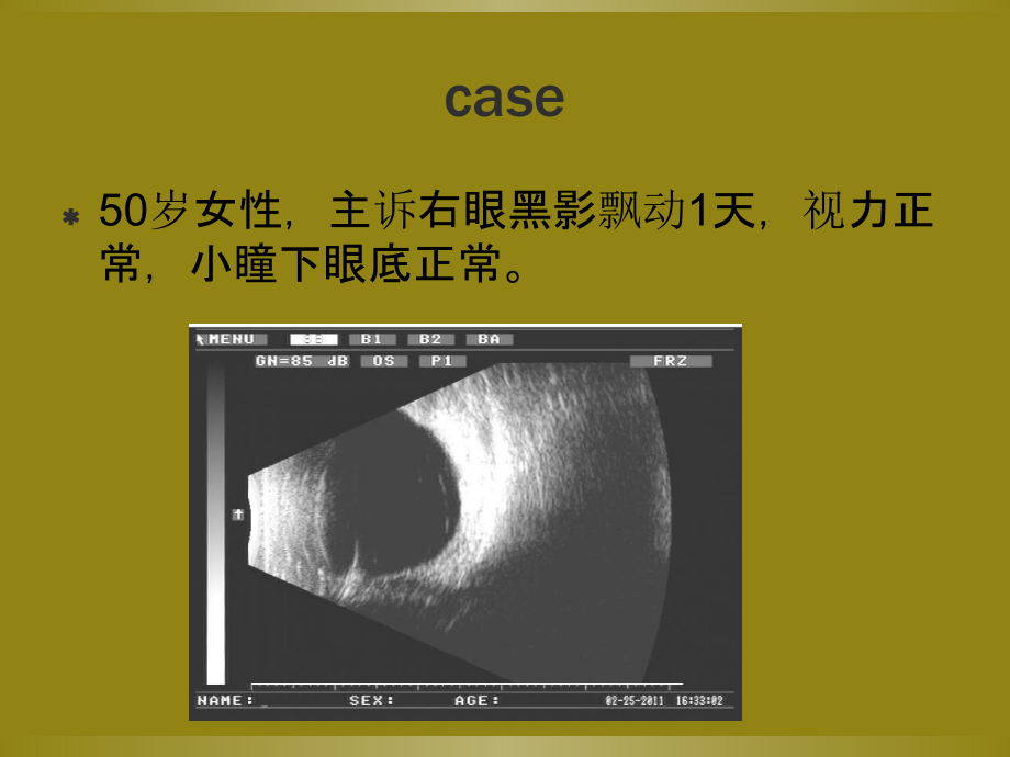 玻璃体后脱离课件.ppt_第2页