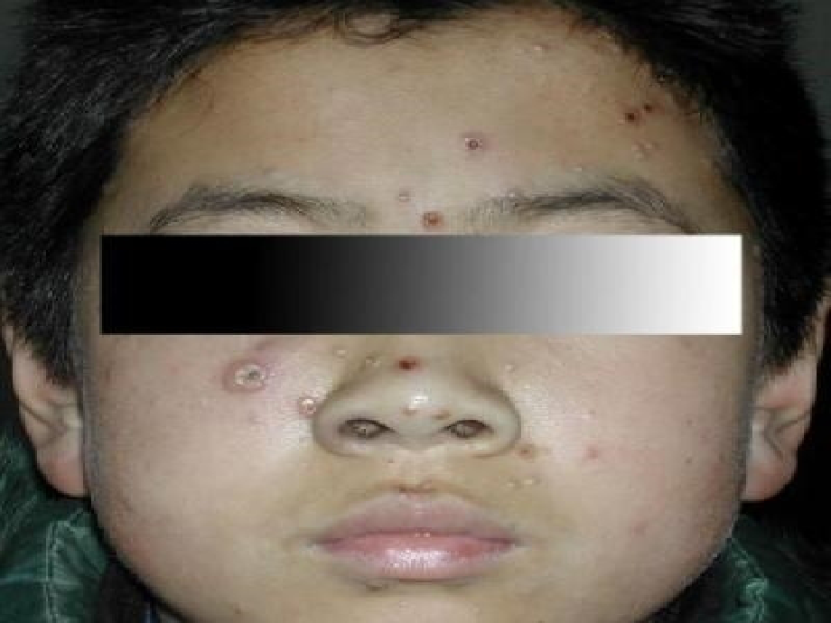 医学预防水痘主题班会PPT.ppt_第2页