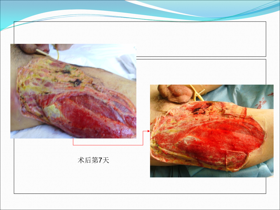 医学课件负压封闭引流技术.ppt_第1页