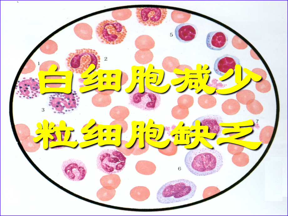 白细胞减少.ppt_第1页