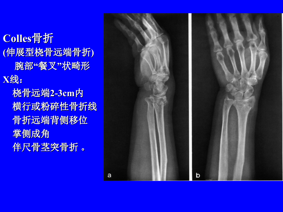 年住院医师规范化培训骨折影像题库.ppt_第2页