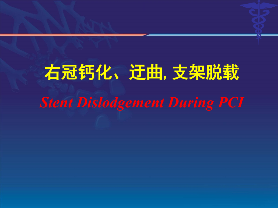 支架脱载-中文-.ppt_第1页