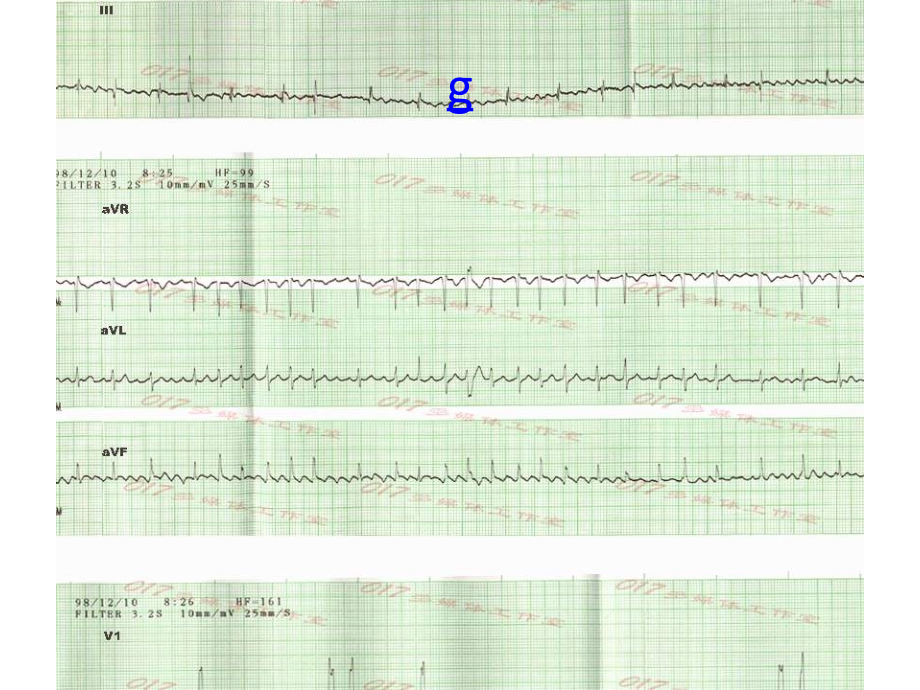 医学课件浅谈心房颤动的射频消融治疗.ppt_第2页