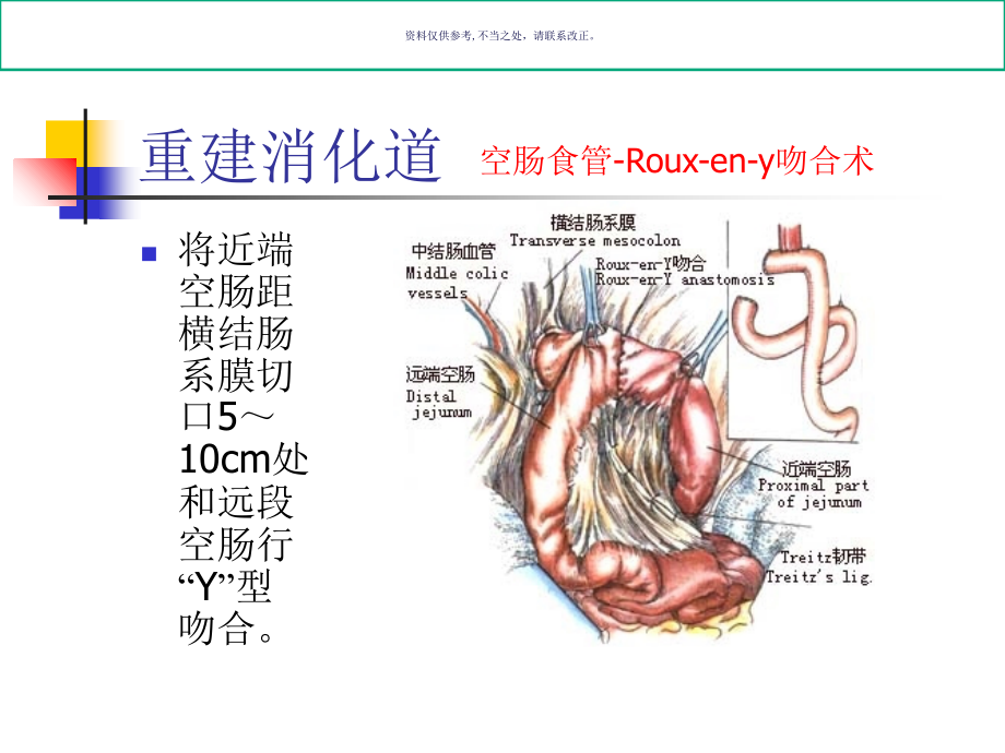 图解全胃切除手术.ppt_第1页