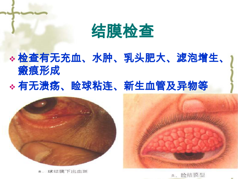 结膜检查医学.ppt_第2页
