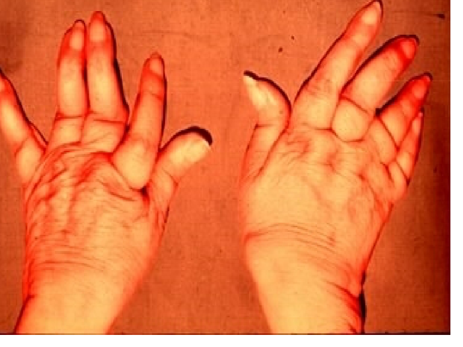 类风湿性关节炎-.ppt_第1页