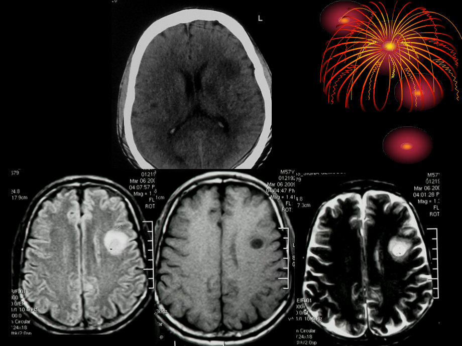 医学肿瘤样脱髓鞘病变影像特征以和鉴别诊疗PPT.ppt_第2页