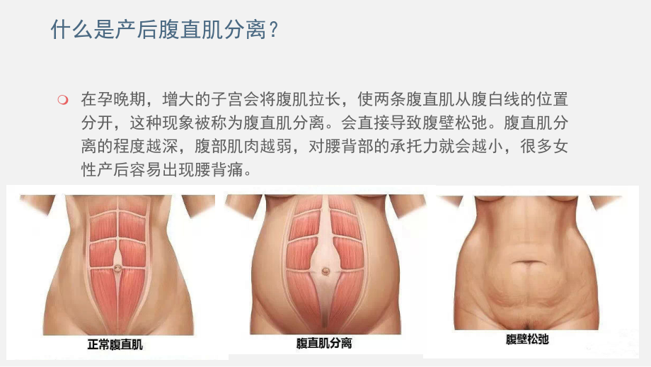 产后腹直肌分离的诊断与治疗讲义.ppt_第2页