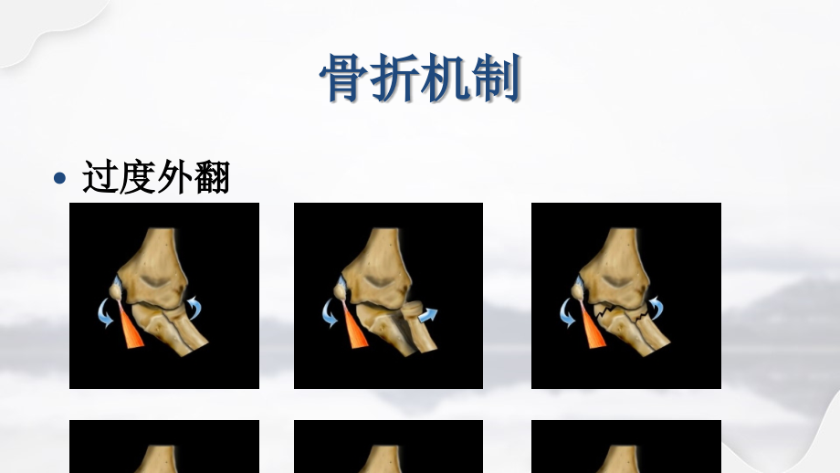 儿童肘关节骨折的X线诊断.ppt_第2页