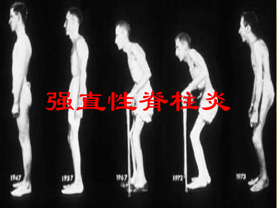 强直性脊柱炎-.pptx_第1页