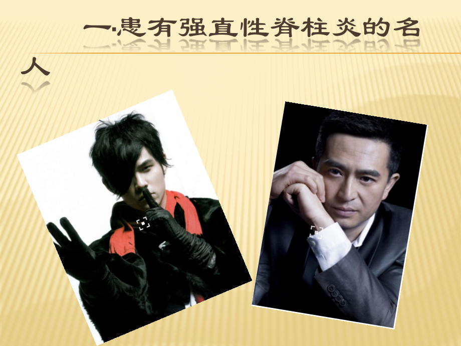 强直性脊柱炎-.pptx_第2页
