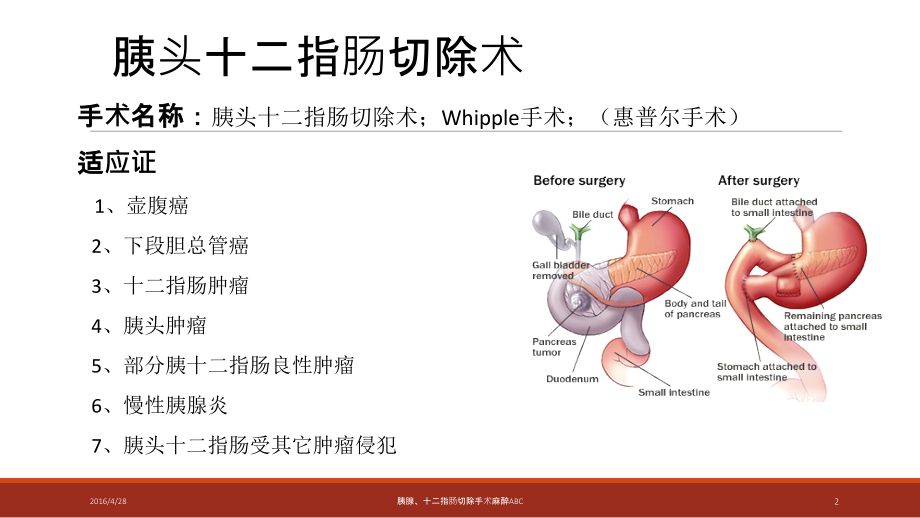 胰腺十二指肠手术麻醉ABC讲义.ppt_第2页