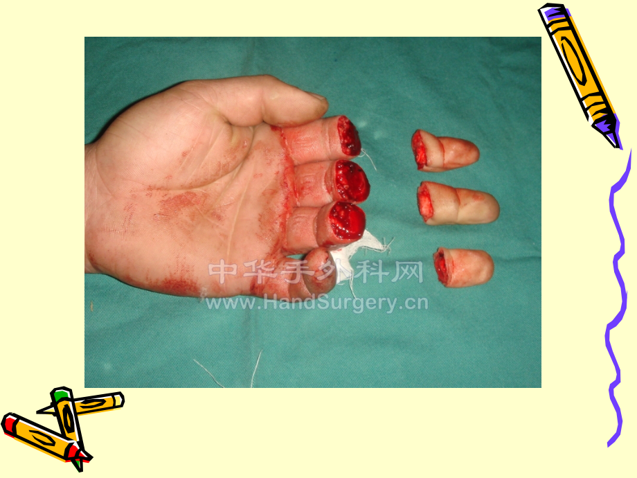 断指再植患者的医疗护理PPT培训课件.ppt_第2页