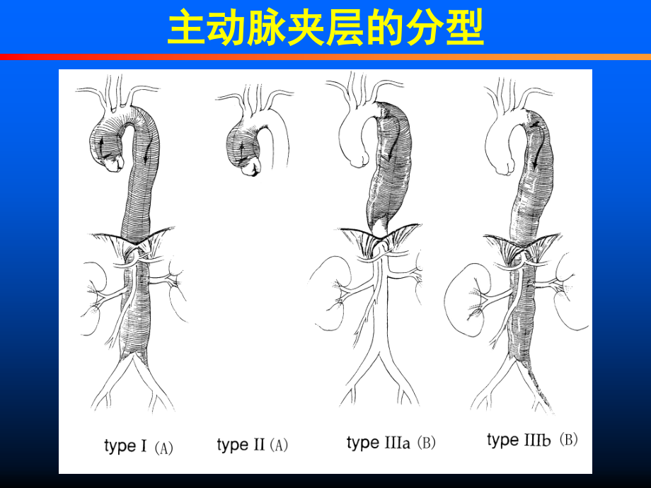 主动脉夹层外科治疗.ppt_第2页