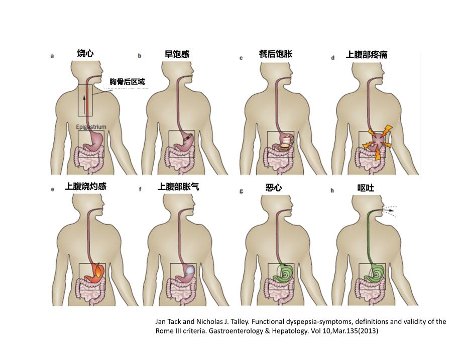 功能性消化不良诊断与治疗.ppt_第2页
