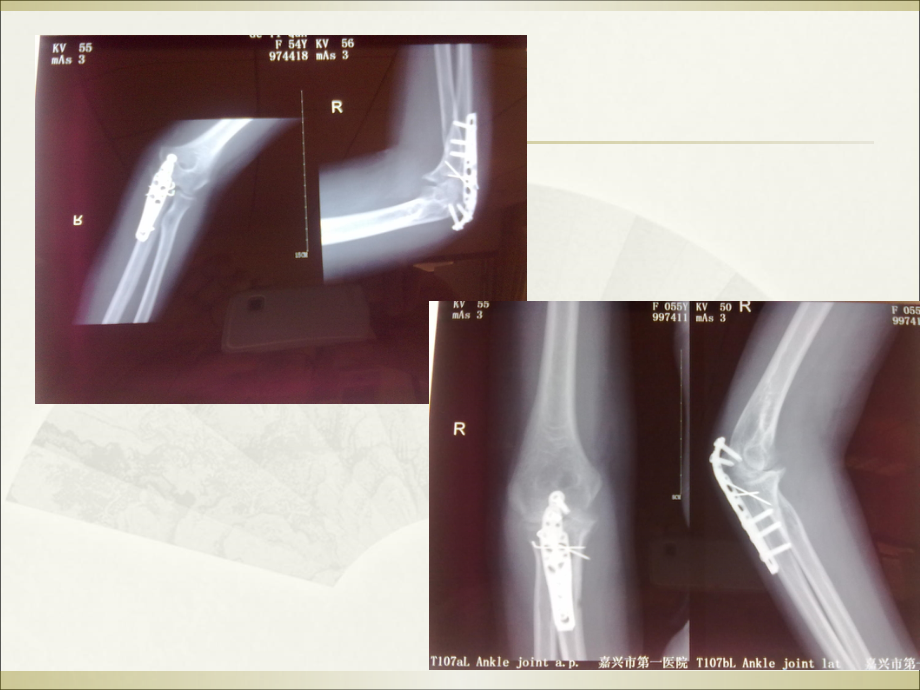 牵伸训练之肌肉能量技术MET在肘关节挛缩中的应用.ppt_第2页