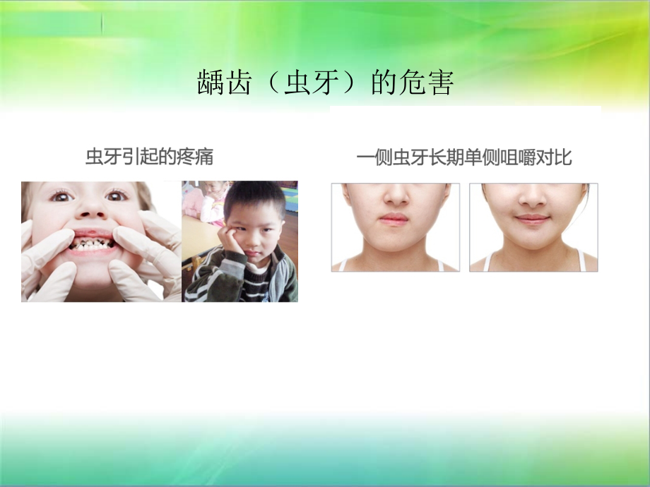 窝沟封闭ppt培训课件.ppt_第2页