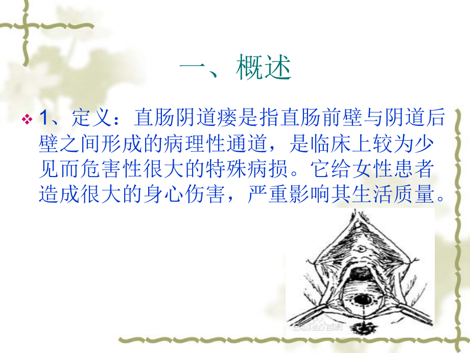 医学课件直肠阴道瘘专业医学知识宣讲.ppt_第1页