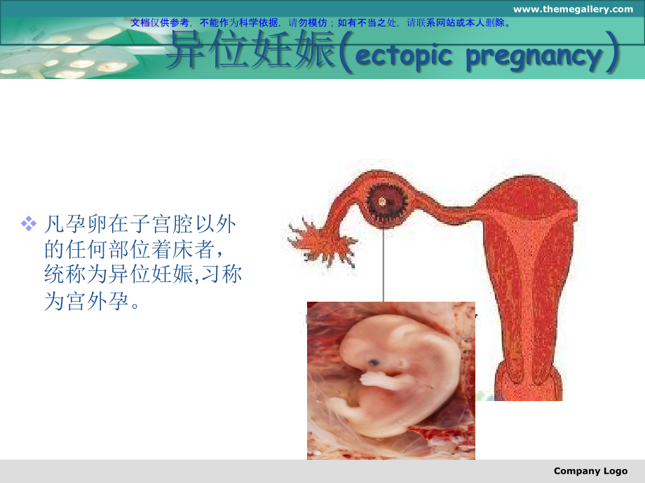 异位妊娠专题宣讲课件.ppt_第1页