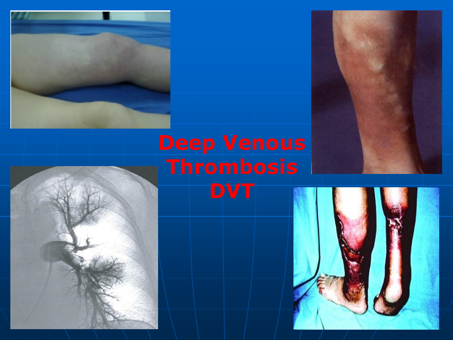 深静脉血栓诊治.ppt_第2页