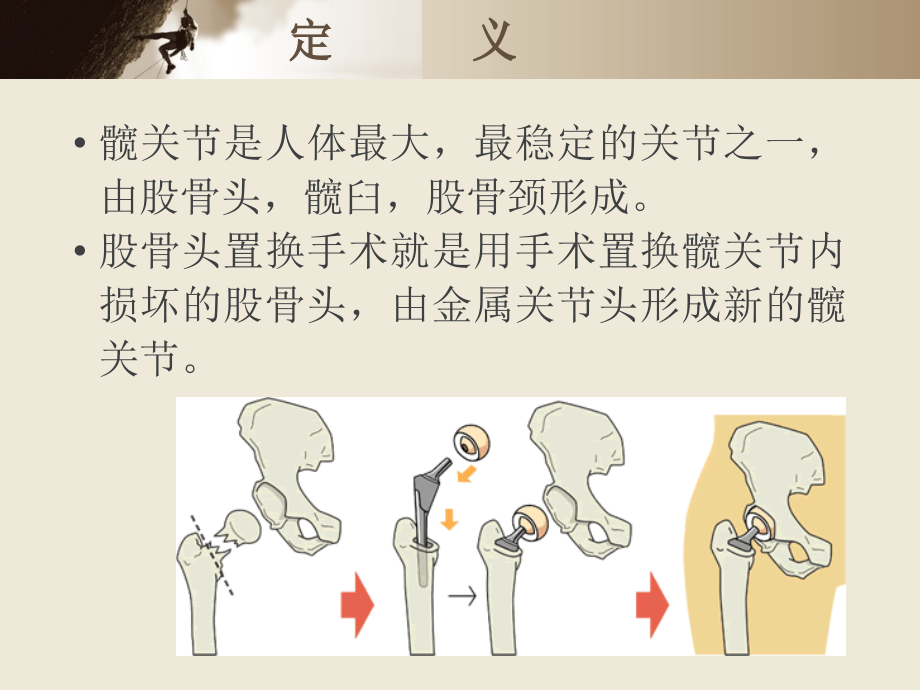 股骨头置换手术的护理查房-.ppt_第2页
