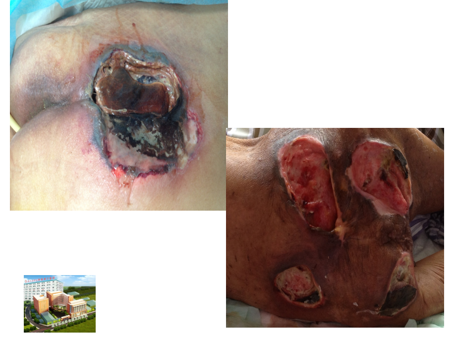 压疮各期的治疗与各种新型敷料的运用.ppt_第2页