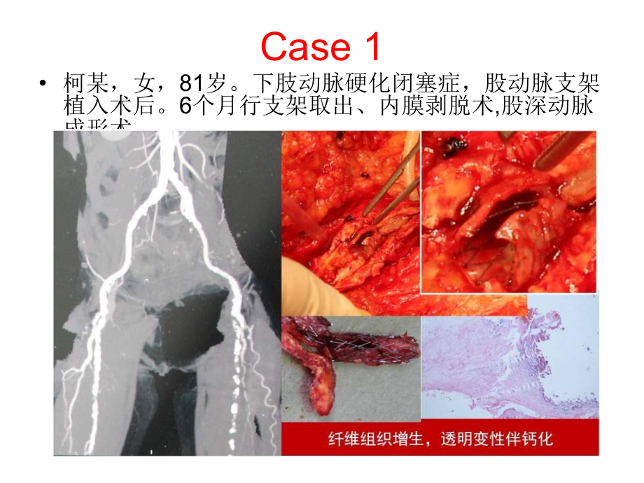 支架内再狭窄的治疗进展.ppt_第2页