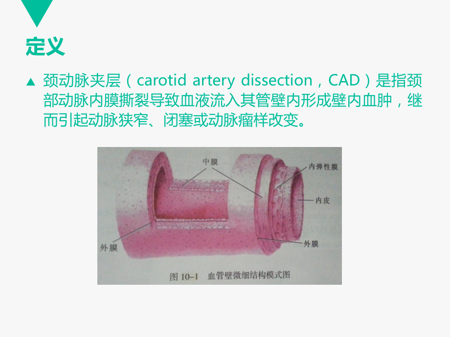 PPT医学课件颈动脉夹层专业知识宣讲讲义.ppt_第1页
