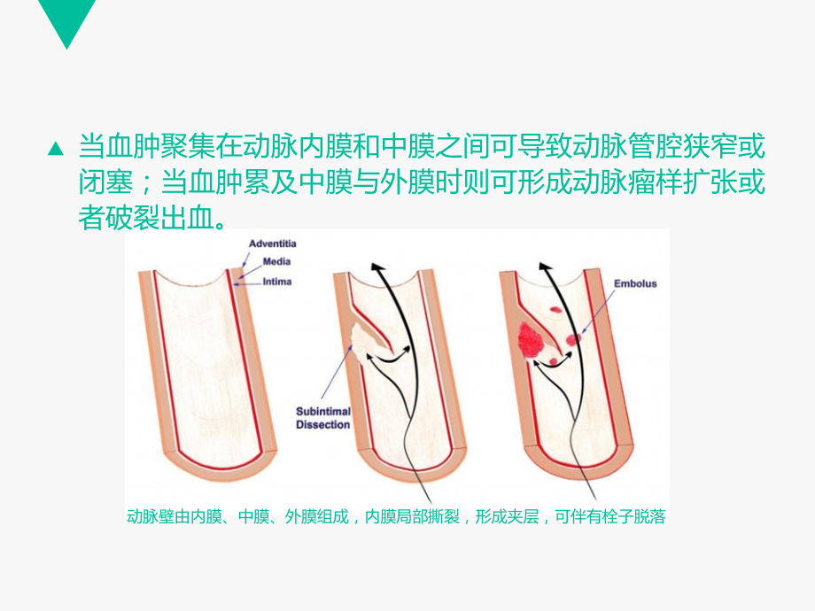 PPT医学课件颈动脉夹层专业知识宣讲讲义.ppt_第2页
