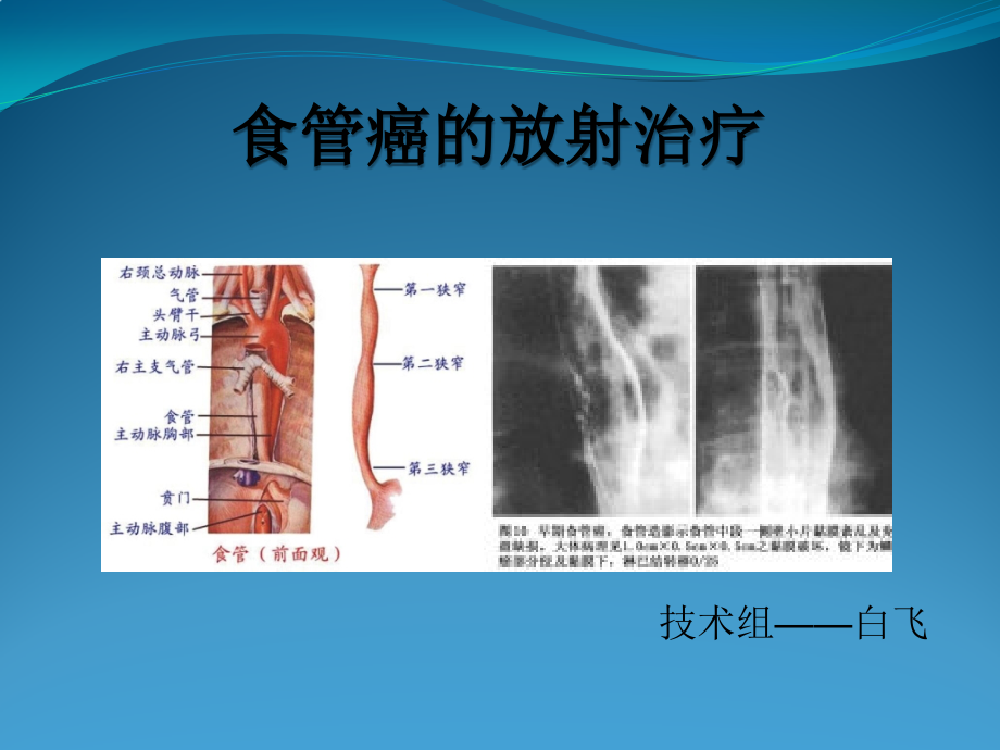食管癌的放射治疗医学.pptx_第1页
