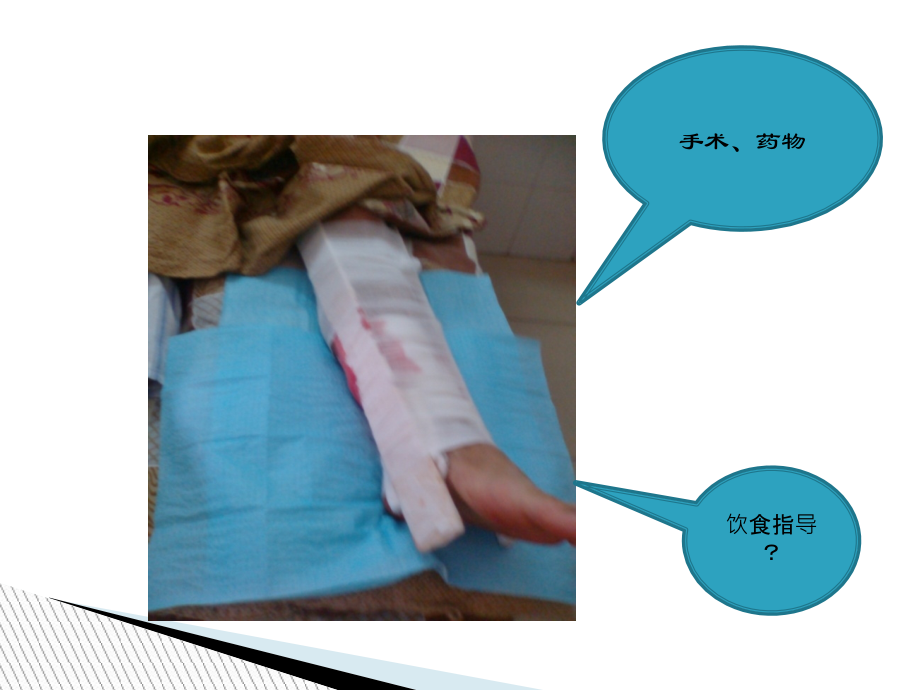 骨折患者的饮食指导讲义.ppt_第2页