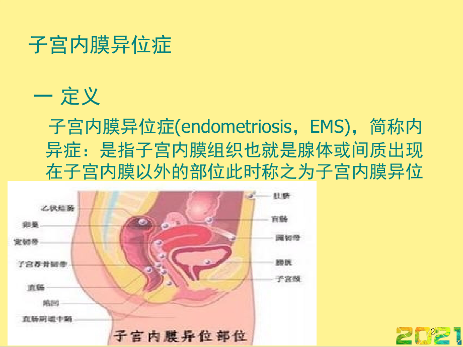子宫内膜异位症诊疗指南完整.ppt_第2页