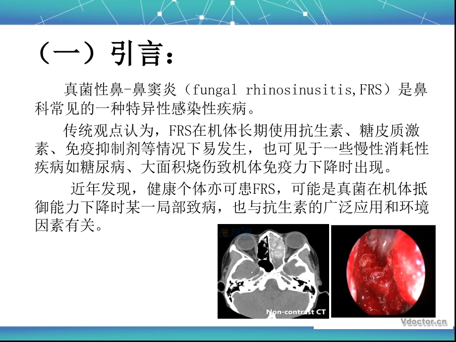 真菌性鼻-鼻窦炎医学.ppt_第2页