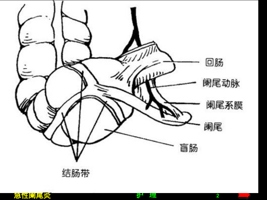 阑尾炎护理.pptx_第2页