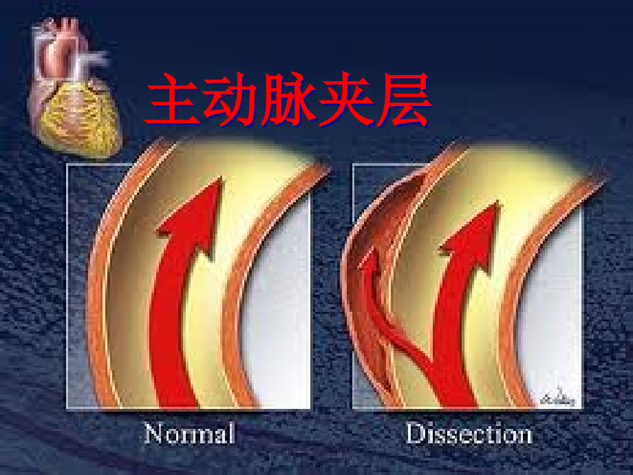 主动脉夹层知识宣教.pptx_第1页