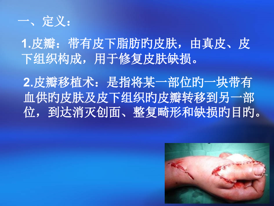 皮瓣移植术后医疗护理.pptx_第2页