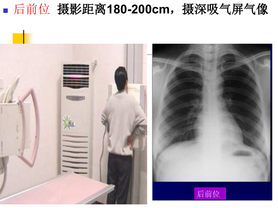 胸部常见疾病的x线表现备选介绍.pptx_第2页