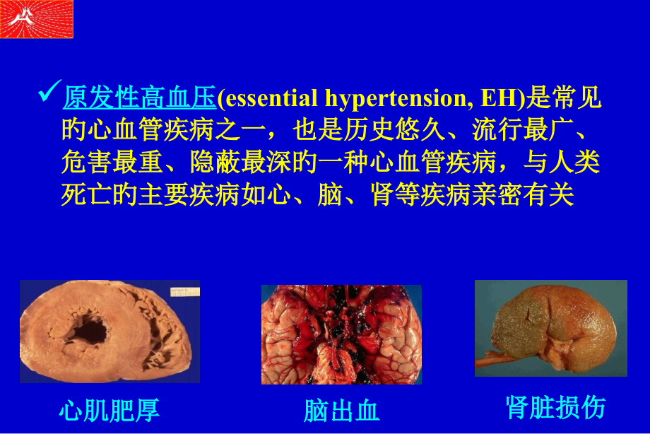 原发性高血压研究的新进展.ppt_第2页