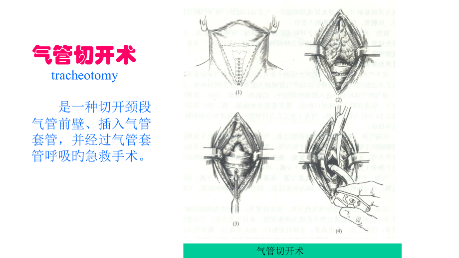 气管切开术后气道护理.pptx_第2页