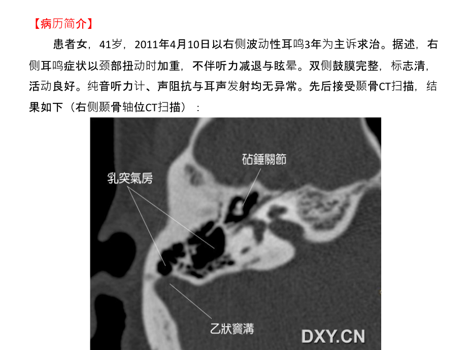 耳鸣和乙状窦憩室.ppt_第2页