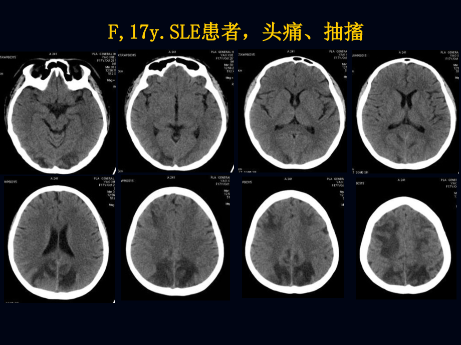 后部可逆性脑病综合征.pptx_第2页